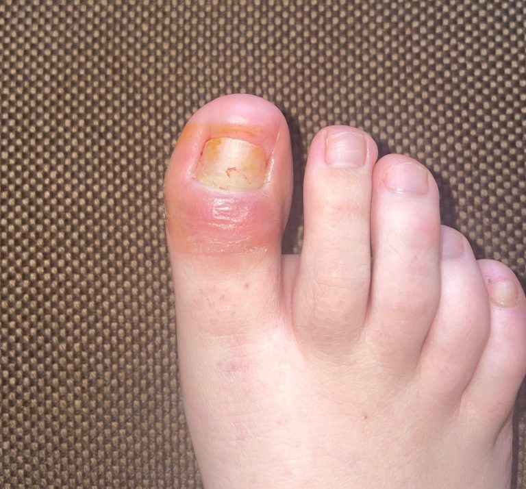 Manchas blancas en las uñas del pie