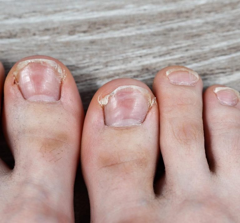 Manchas blancas en las uñas del pie